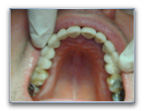 couronnes sur implant dentaire