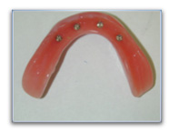 prothèses dentaires complètes amovibles sur implants